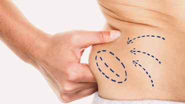 Is Liposuction Right For Your_ - Finger and Associates