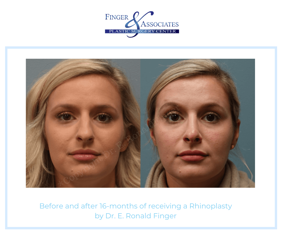 Finger and Associates Before and After Rhinoplasty