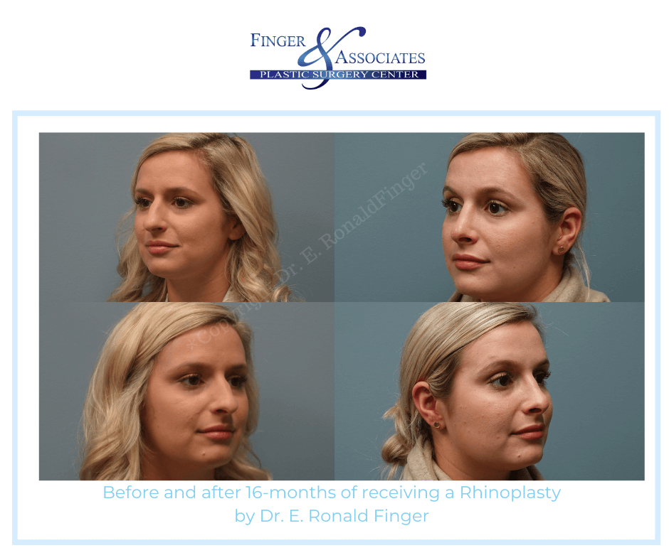 Finger and Associates Before and After Rhinoplasty