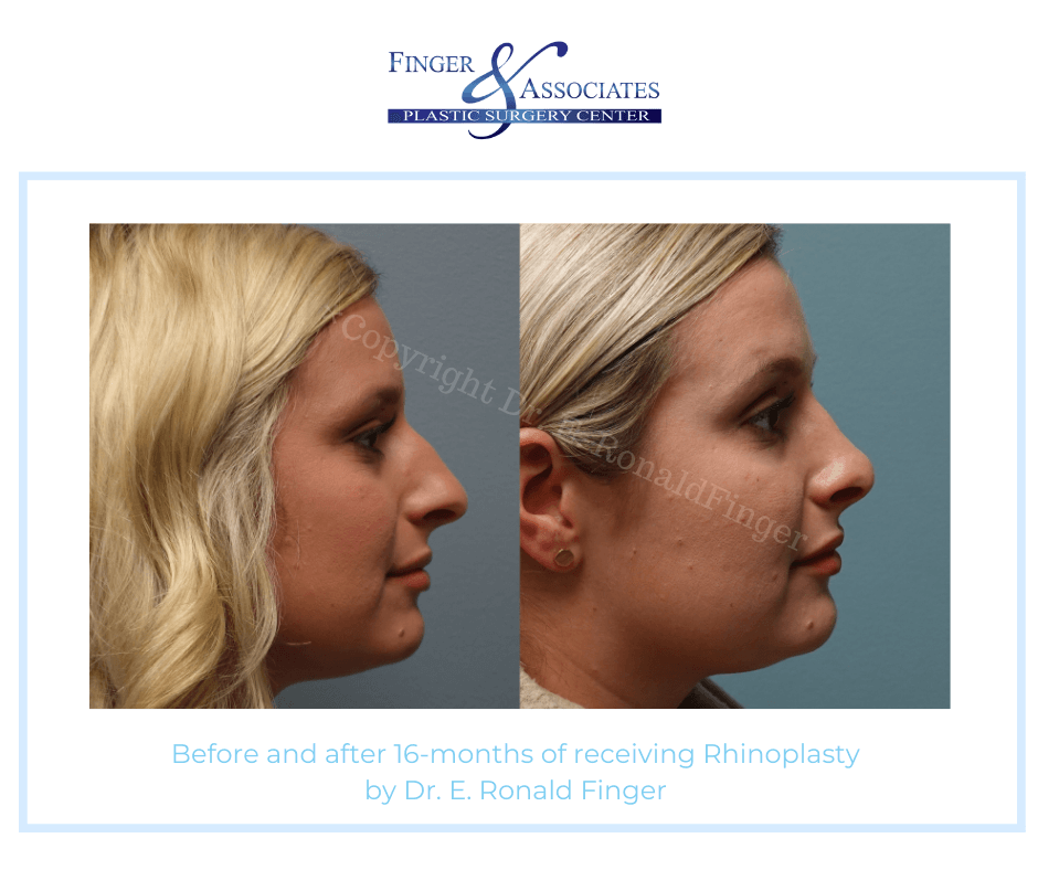 Finger and Associates Before and After Rhinoplasty