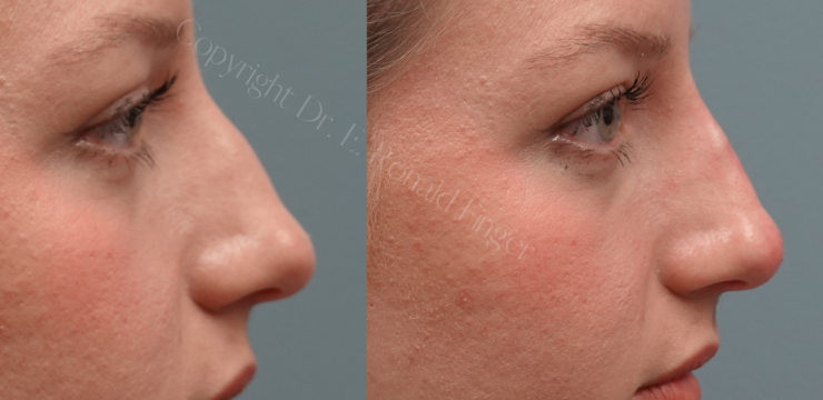 Before and after Liquid Rhinoplasty