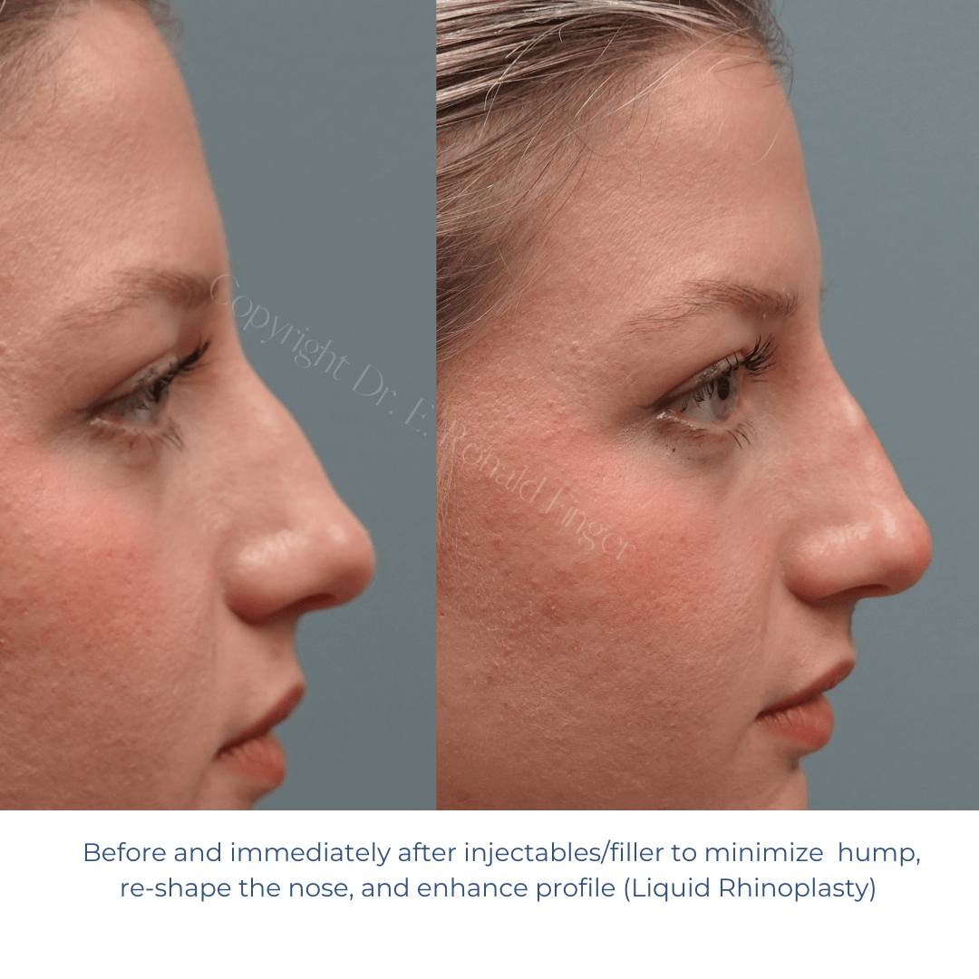 Before and after Liquid Rhinoplasty