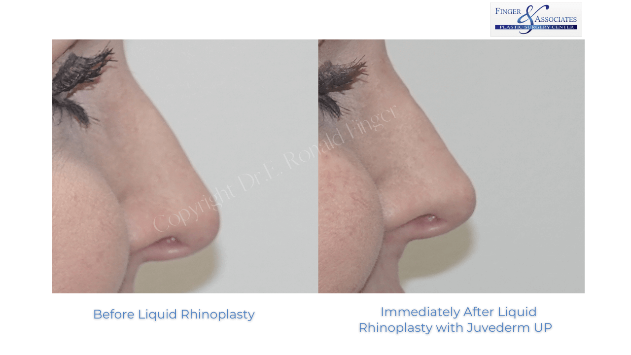 Before and After Rhinoplasty Gallery Dr. E. Ronald Finger