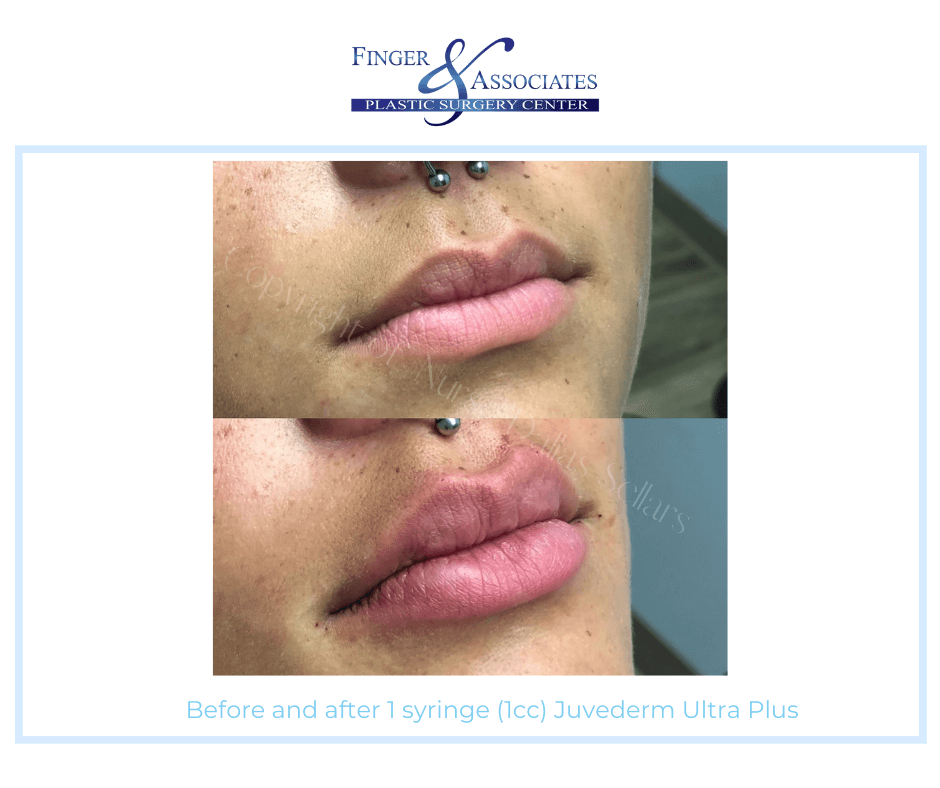 Before and after 1 syringe (1cc)  Juvederm Ultra Plus by Nurse Dallas Sellars