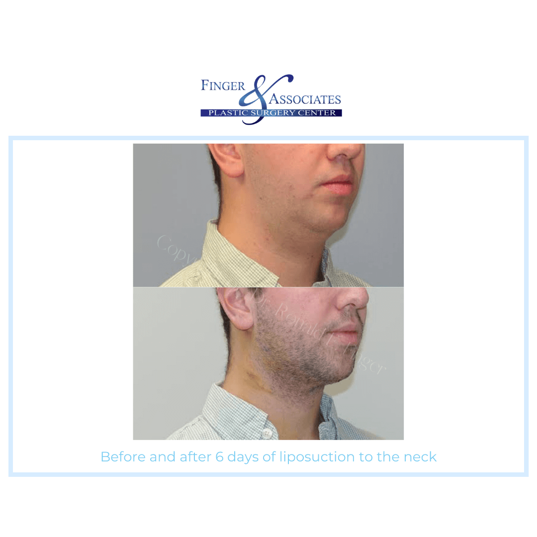 Before and after 6 days of liposuction to the neck by Dr. Finger - Finger and Associates