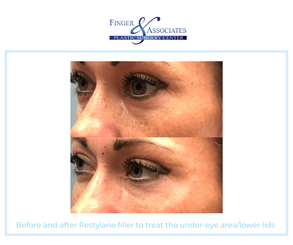 Before and after Restylane filler to treat the under-eye area_lower lids