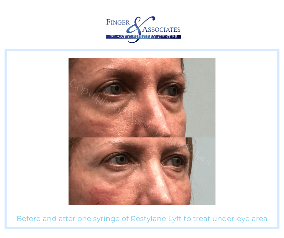 Before and after one syringe of Restylane Lyft to treat under-eye area by Dallas Sellars - Finger and Associates