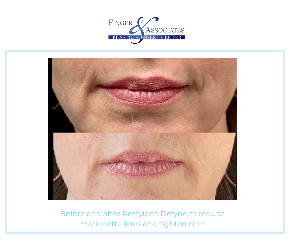 Before and after Restylane Defyne to reduce marionette lines and tighten chin by Nurse Dallas Sellars