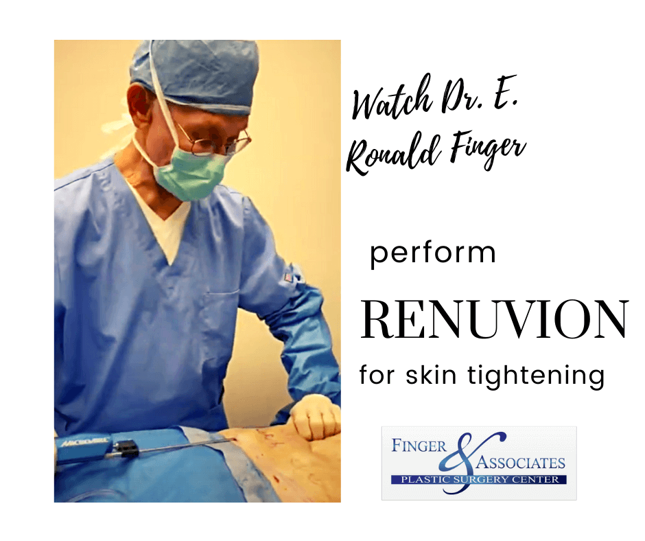 Renuvion by Dr. Finger