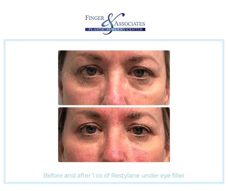 Finger and Associates Before and After - Before and after 1 cc of Restylane under eye filler by Nurse Dallas Sellars