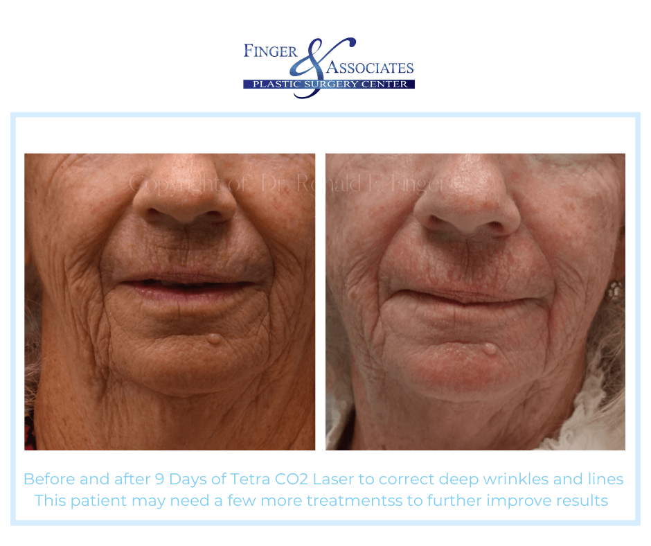 Before and after 9 days of Tetra CO2 by Dr. E. Ronald Finger Before and after 9 Days of Tetra CO2 Laser Skin Resurfacing