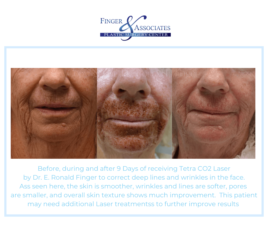 Before during and after 9 days of Tetra CO2 by Dr. E. Ronald Finger Tetra CO2 Laser Results