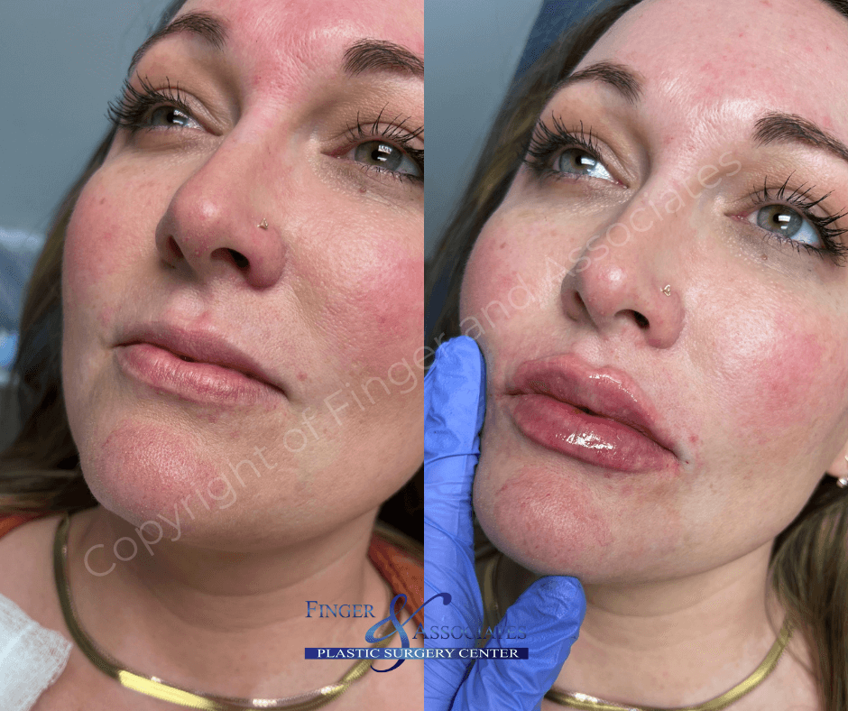 Before and immediately after Lip Filler by Nurse Dallas Sellars 