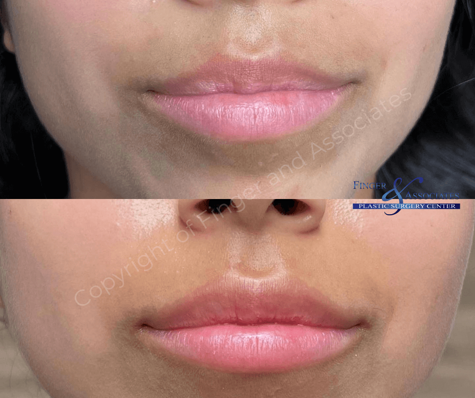 Before and after Versa Lip Filler Before and after Versa Lip Filler by Dr E.Ronald Finger