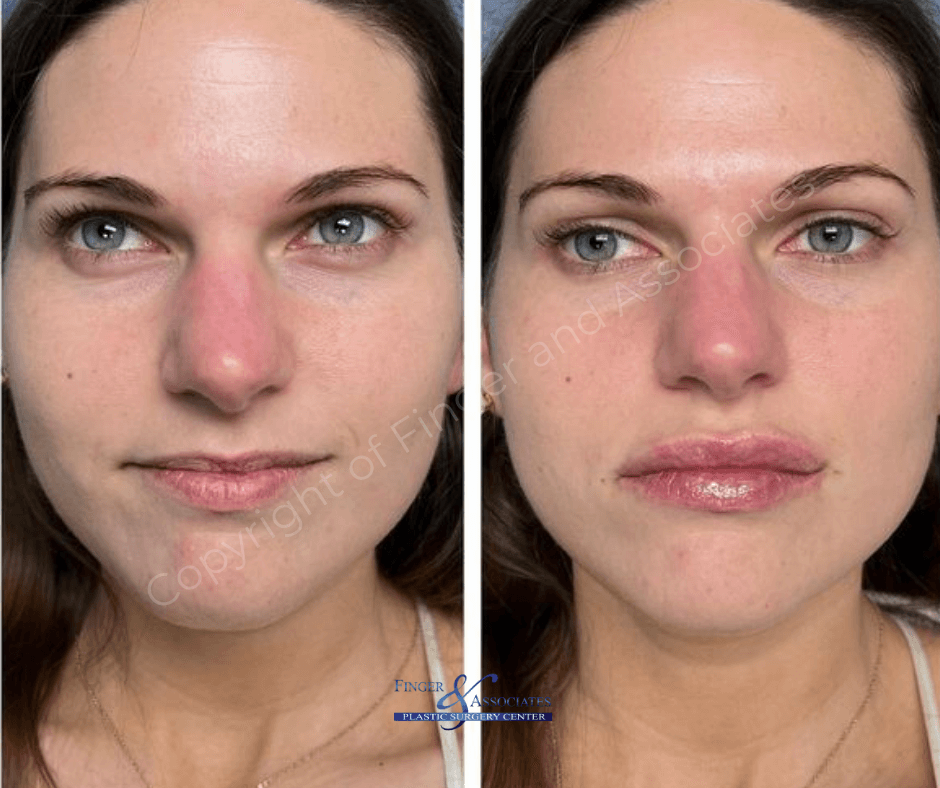 Before and after Versa Lip Filler by E.Ronald Finger- Finger and Associates