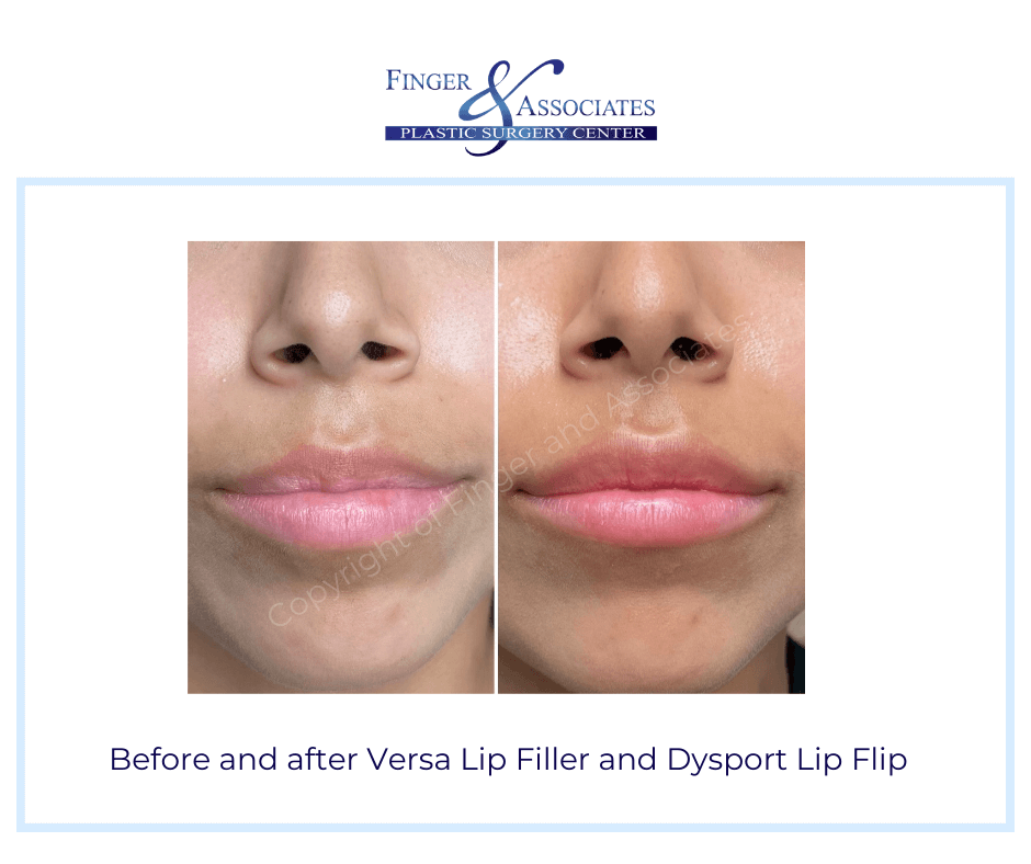 Before and after Versa Lip Filler by Nurse Dallas