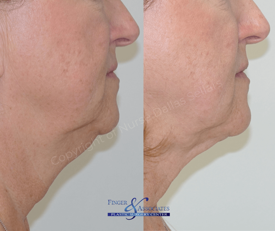 Before & 19 months after liposuction and Renuvion of the lower face & neck - Finger and Associates