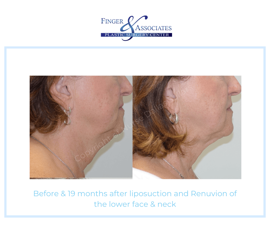 Before & 19 months after liposuction and Renuvion of the lower face & neck - Finger and Associates