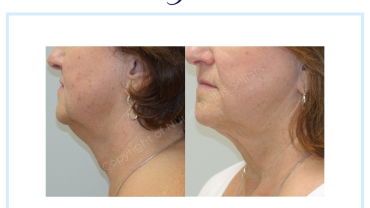 Before & 19 months after liposuction and Renuvion of the lower face & neck - Finger and Associates