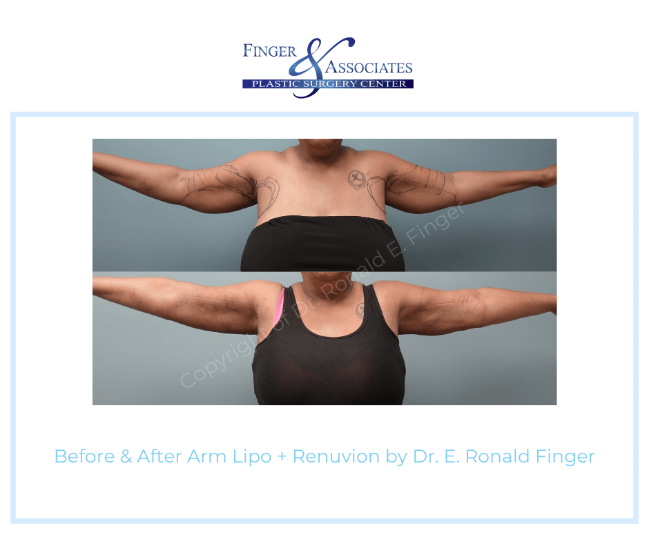 Before & After Arm Lipo + Renuvion by Dr. E. Ronald Finger