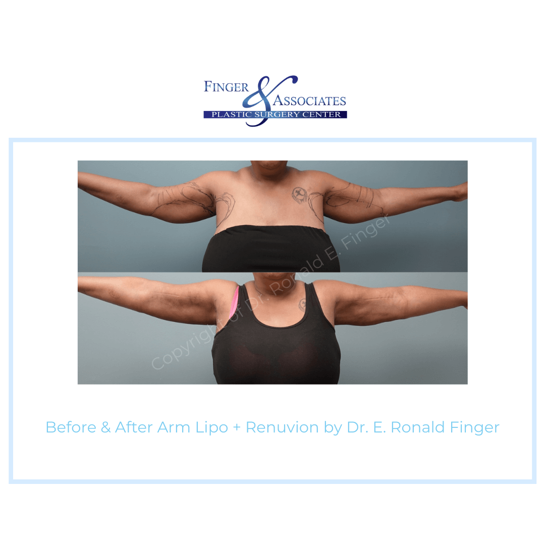 Before & After Arm Lipo + Renuvion by Dr. E. Ronald Finger