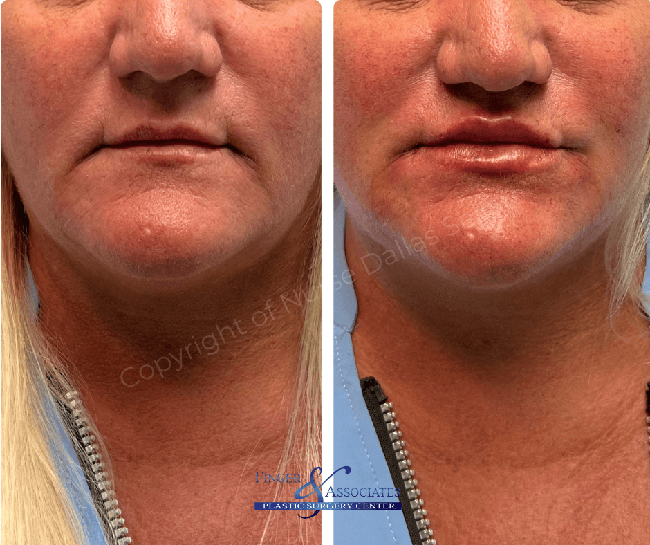Before and after lip filler and filler to treat marionette lines