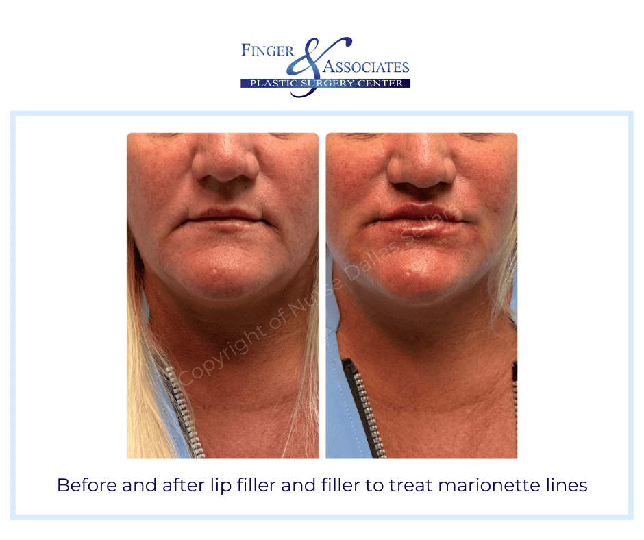Before and after lip filler and filler to treat marionette lines by Nurse Dallas