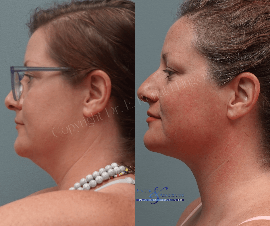 Before and 1 year after liposuction of the lower face and neck + Renuvion - Finger & Associates