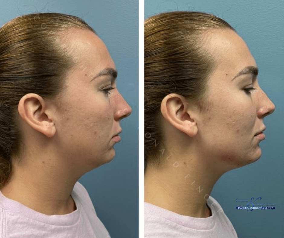 Before and After Restylane Lyft Filler to enhance Jawline and Chin for a Naturally more Sculpted and Contoured - Finger & Associates