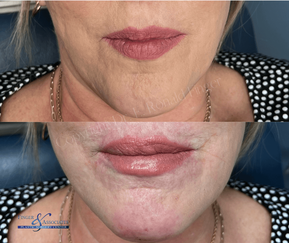 Before and after KYSSE and Chin Filler by Nurse Dallas Sellars
