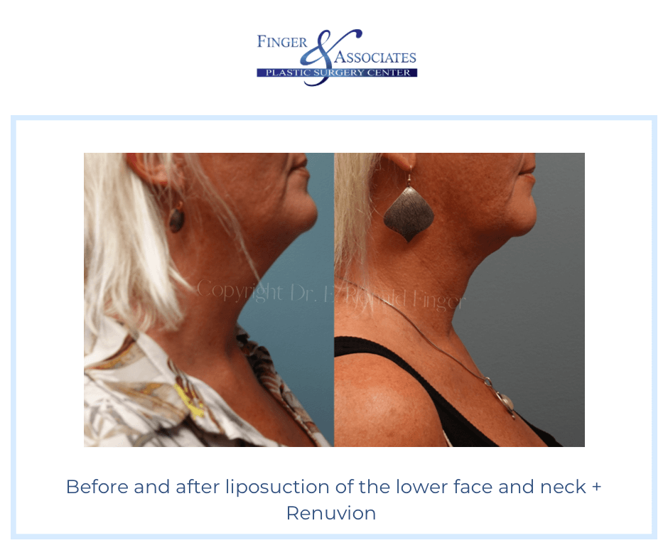 before and after Liposuction and Renuvion by Dr. Finger
