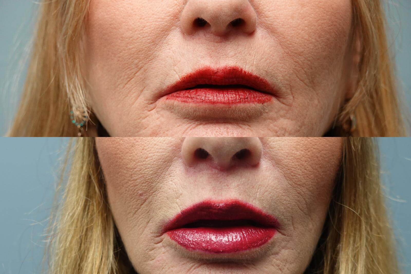 Before and After 4 month of Bullhorn Lip Lift by Dr Finger to correct asmmetry and to shorten distance between nose and upper lip