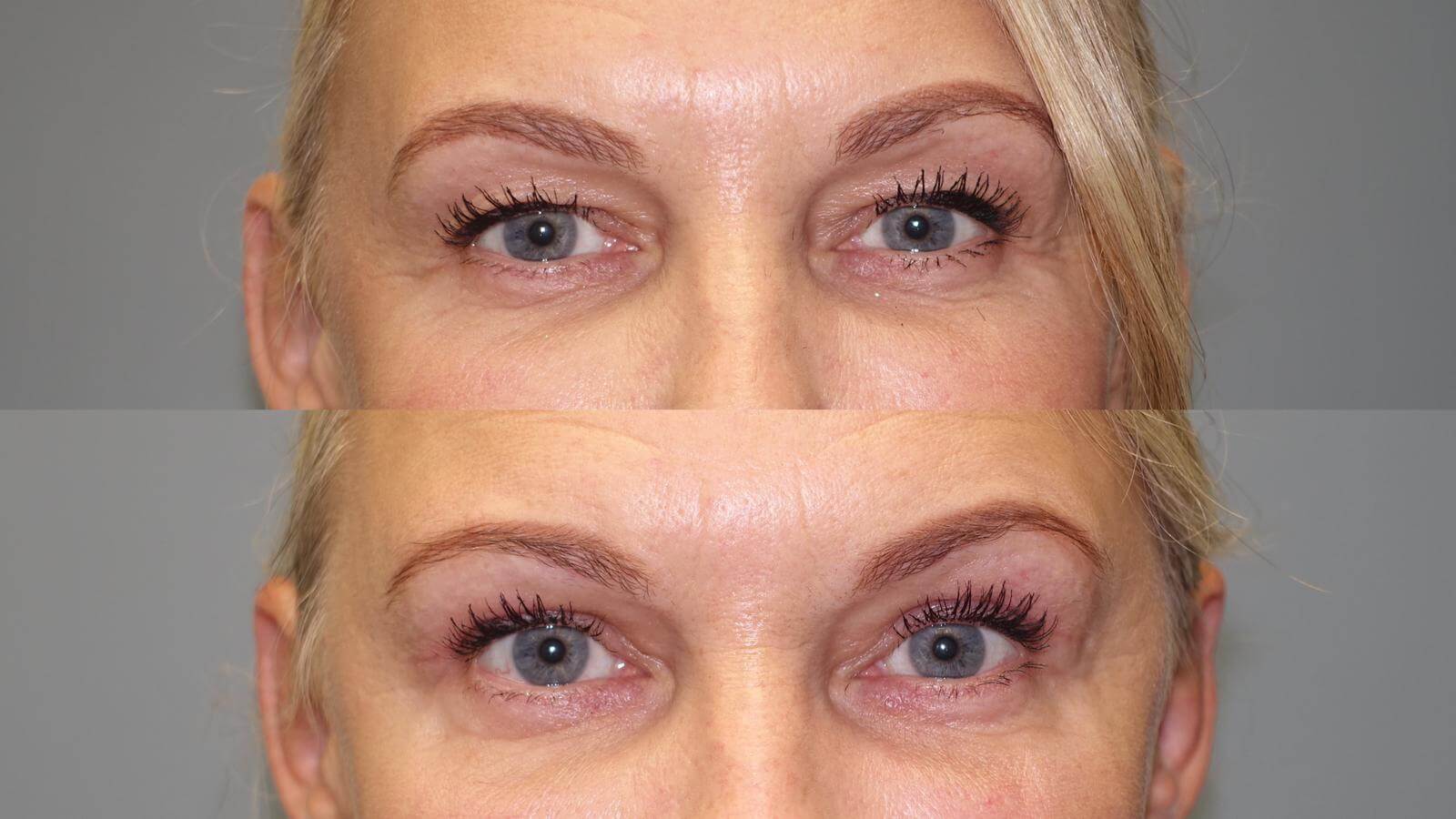 Before and After Eyelid lift -this corrected facial asymmetry caused by droopy upper eyelids. Look at the left versus the right eye on the before picture. The result speaks for itself