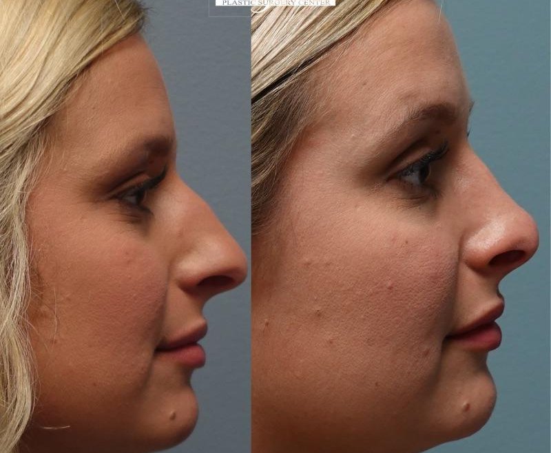 Before and After Rhinoplasty to remove hump and to reshape the nose. Facial asymmetry before and facial symmetry afterward Amazing result