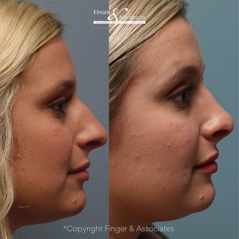Before and After Rhinoplasty to remove hump and to reshape the nose. Facial asymmetry before and facial symmetry afterward Amazing result