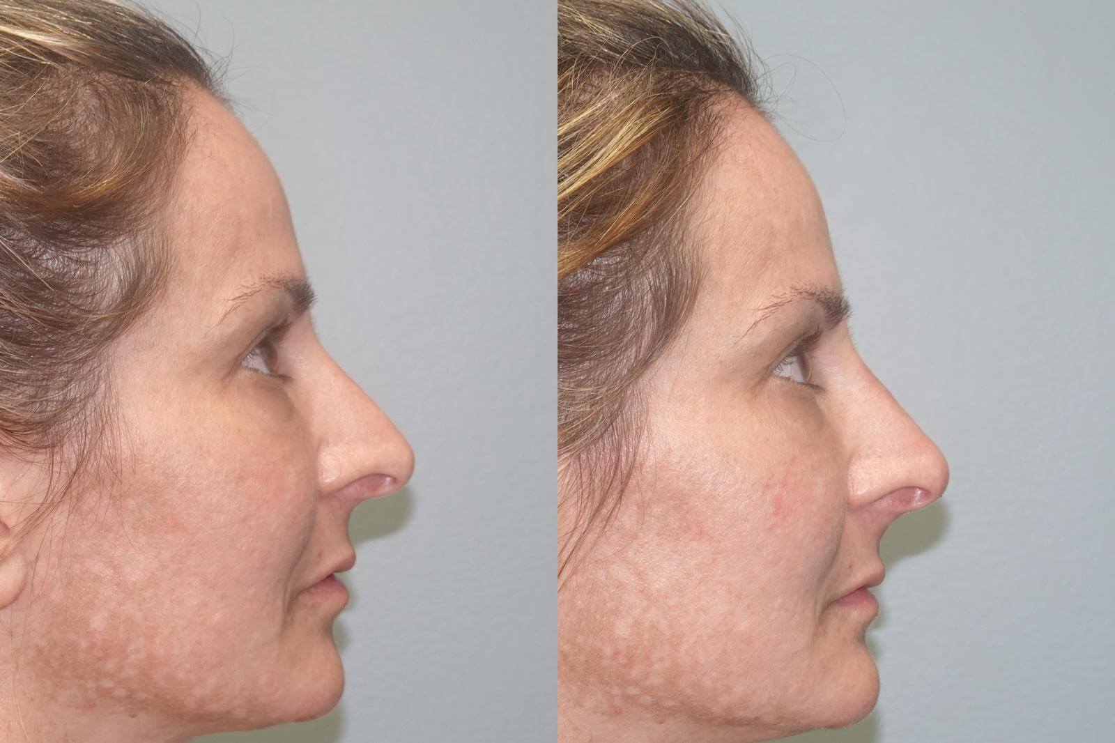 Before and After Nonsurgical nose job with 1/2 syringe of Belafill to correct facial asymmetry