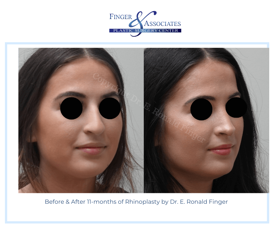 Before and after 11-months of Rhinoplasty results - Finger and Associates