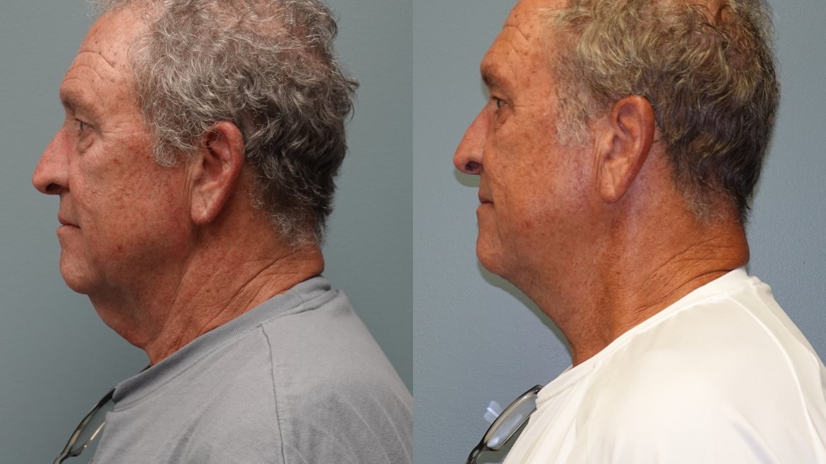 Before and after neck liposuction and skin excision of the neck