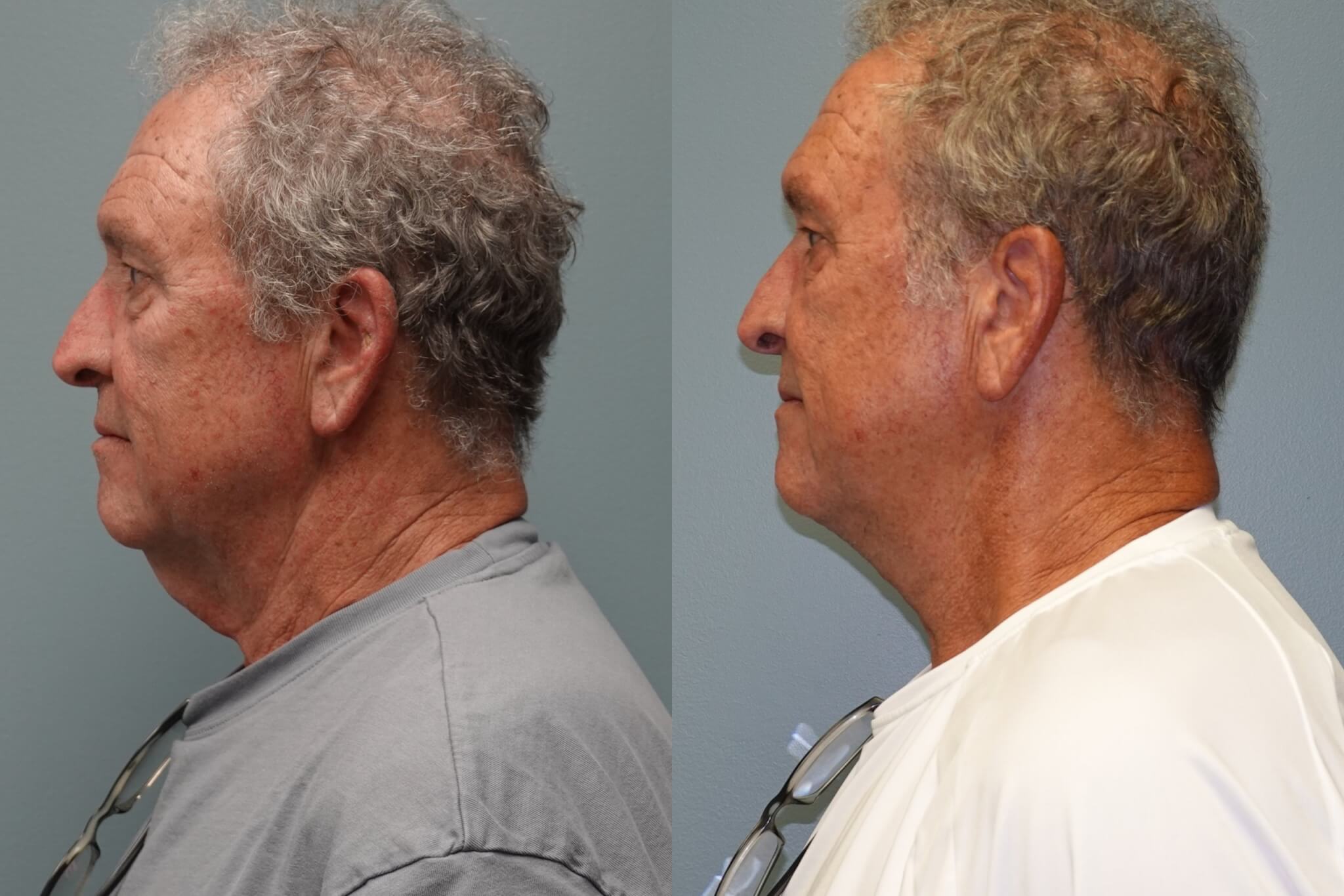 Before and after 5 weeks of neck liposuction and skin excision on the neck. Before and after neck liposuction and skin excision of the neck