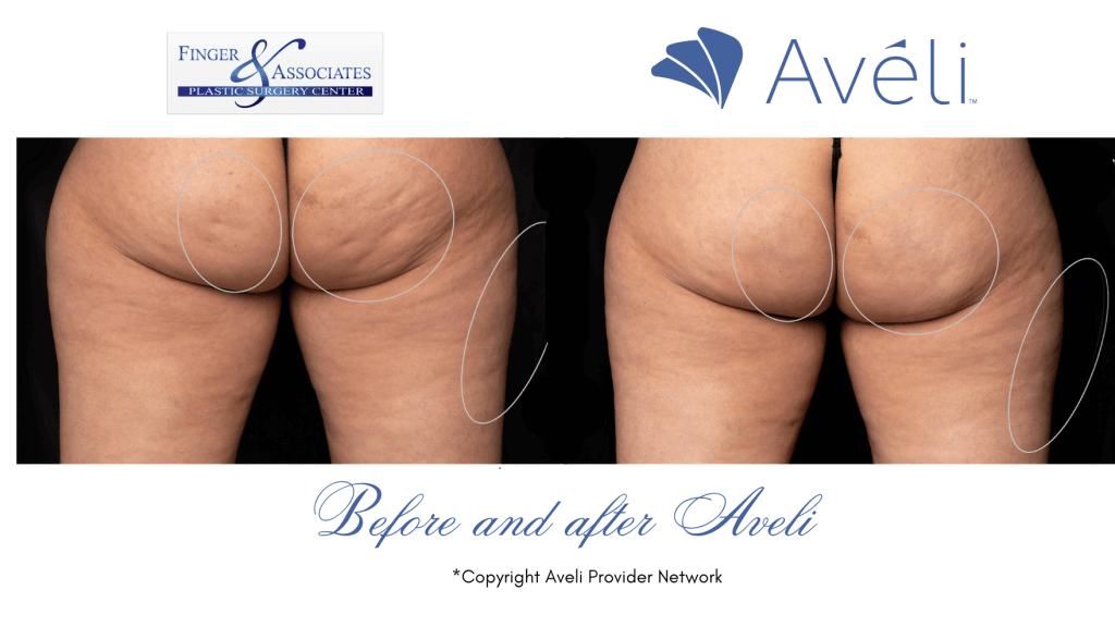 Before and after Aveli to treat Cellulite