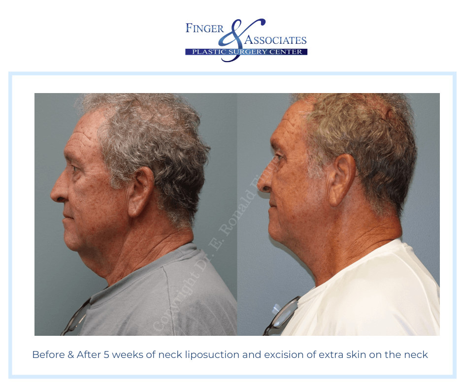 Before and after 5 weeks of neck liposuction and skin excision on the neck.