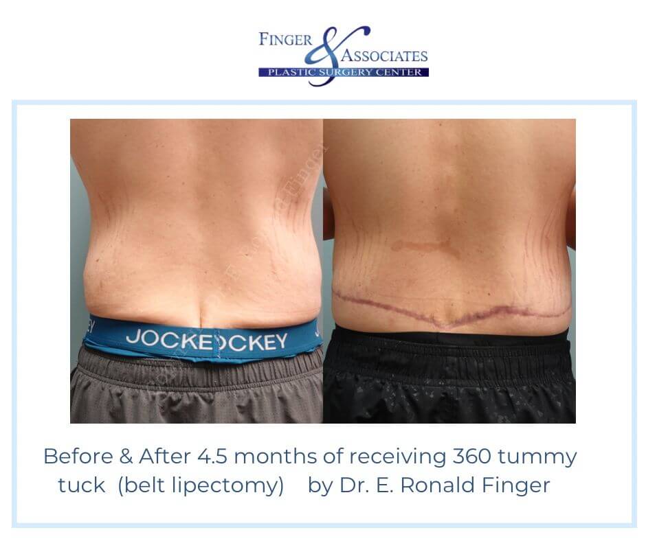 Before-After-4.5-months-of-receiving-360-tummy-tuck-belt-lipectomy-by-Dr.-E.-Ronald-Finger