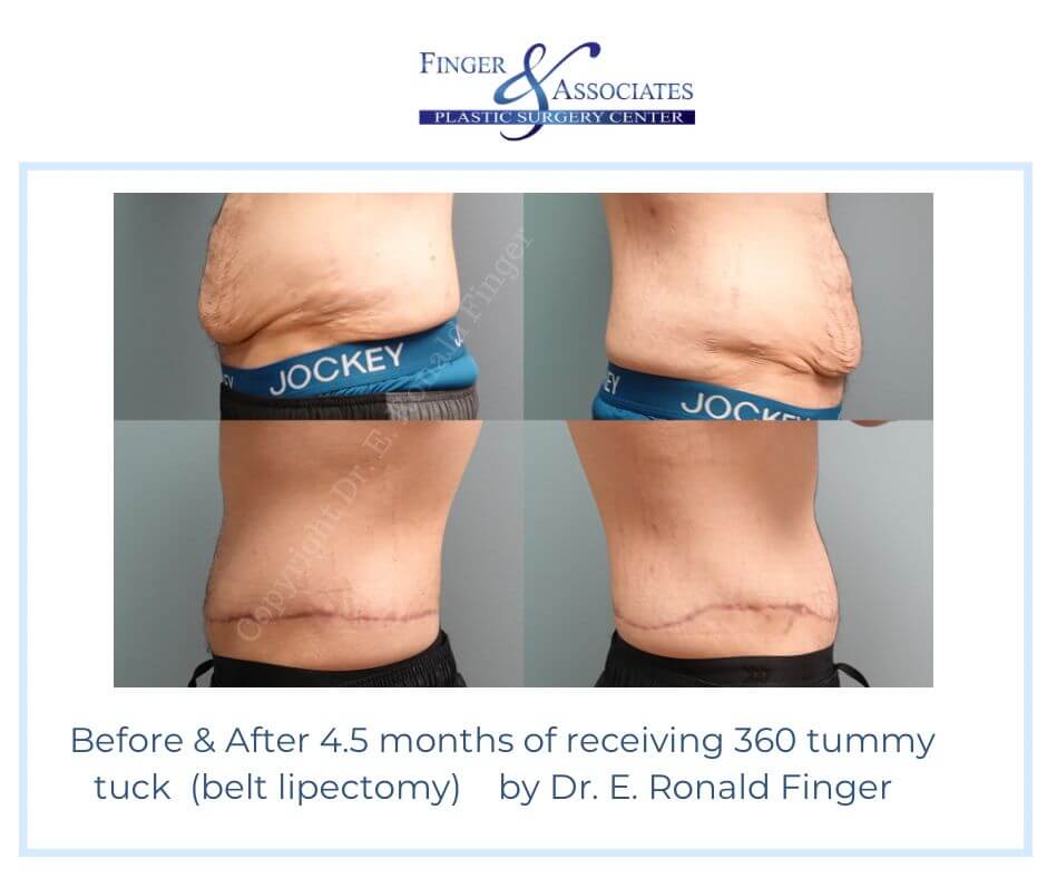 Before-After-4.5-months-of-receiving-360-tummy-tuck-belt-lipectomy-by-Dr.-E.-Ronald-Finger