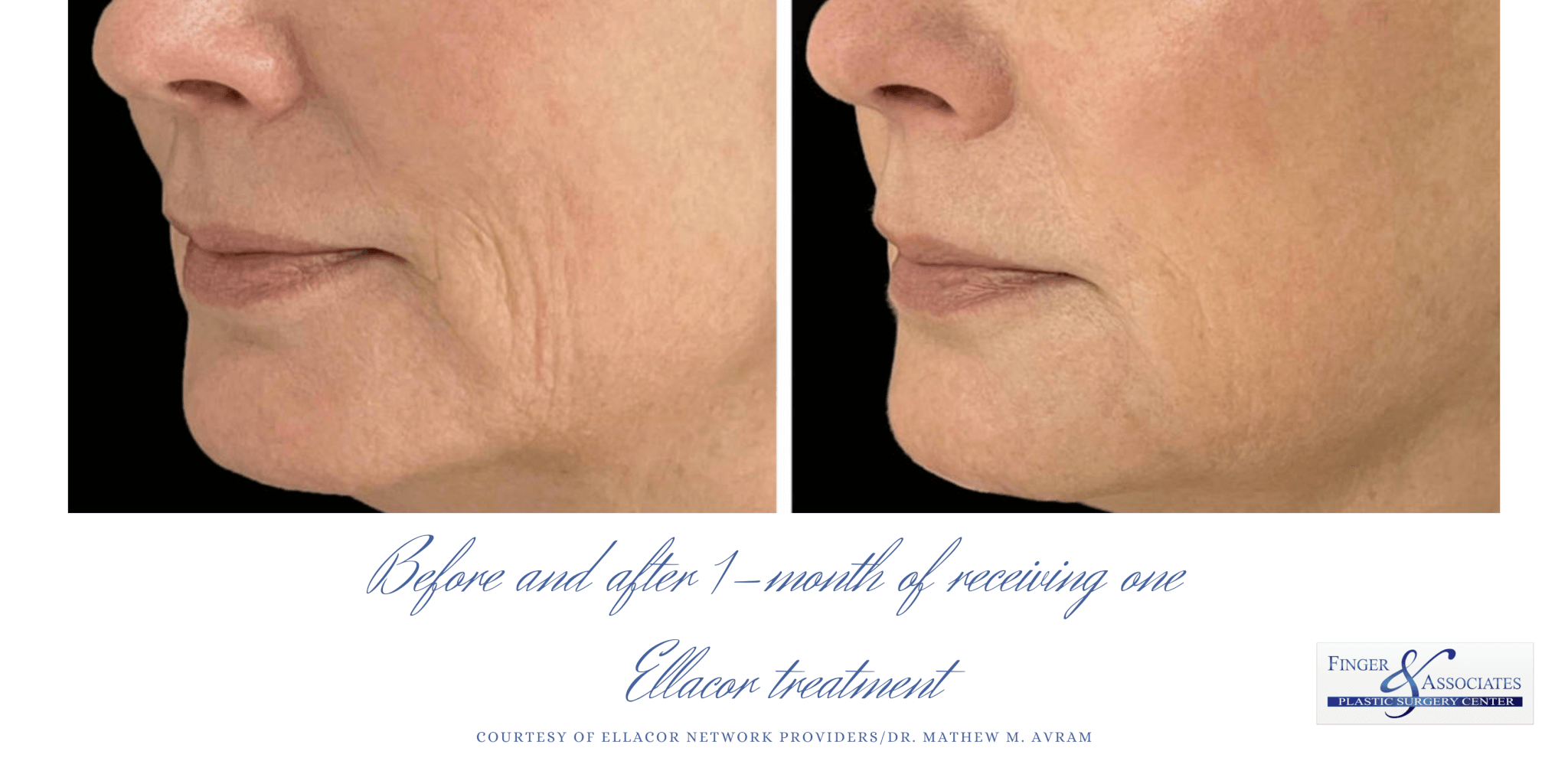 Before and after 1 month of one Ellacor procedure Ellacor skin tightening is now available in Savannah