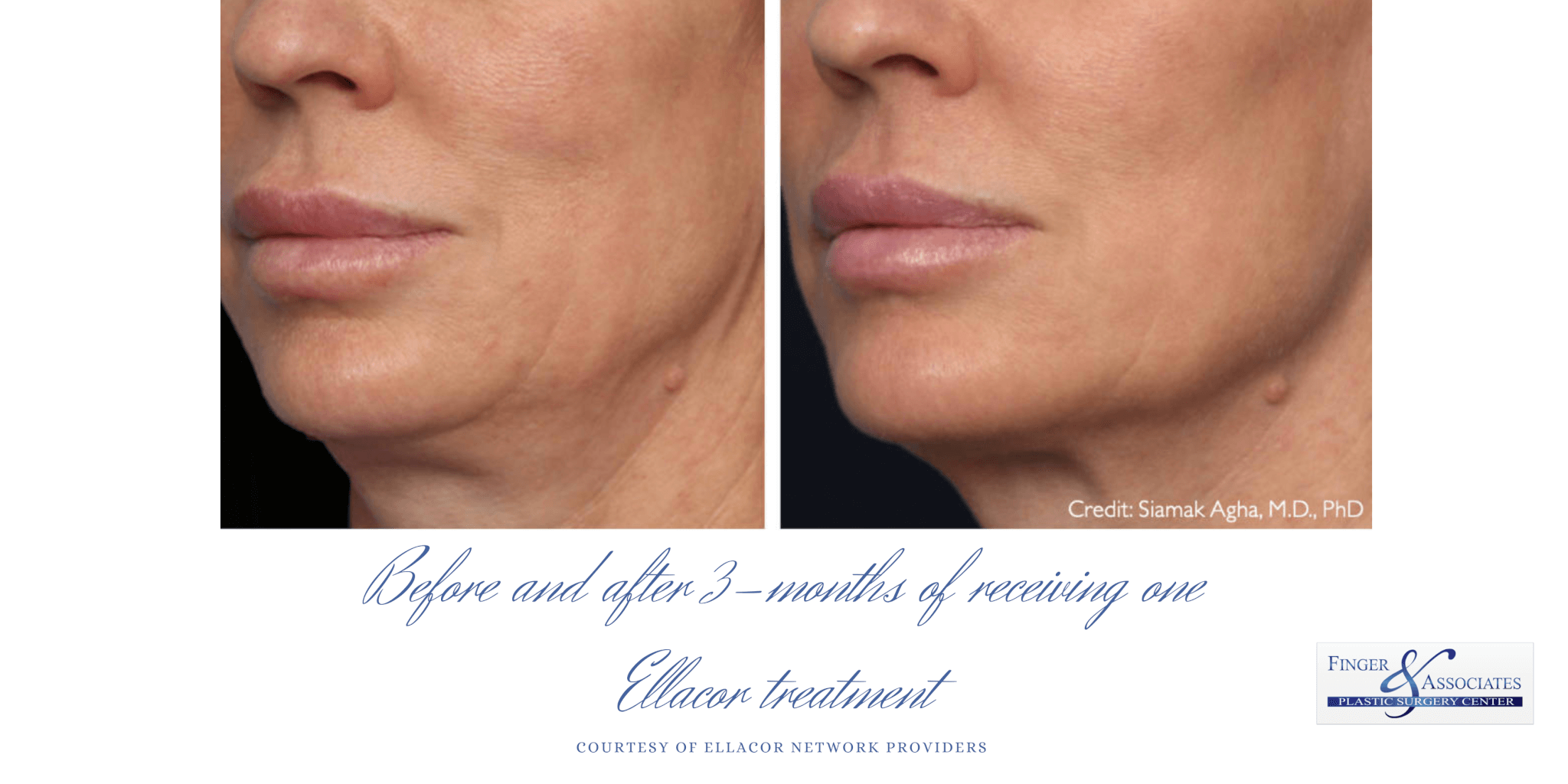 Before and after 3 months of one Ellacor procedure (2) Ellacor skin tightening is now available in Savannah