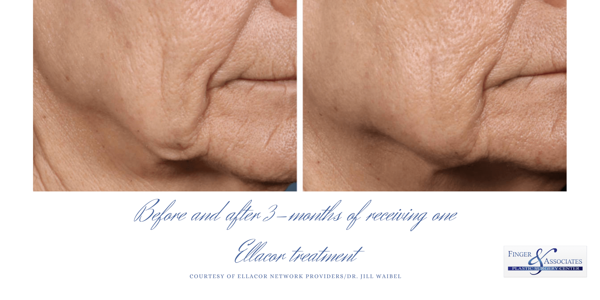 Before and after 3 months of one Ellacor procedure (3) Ellacor skin tightening is now available in Savannah