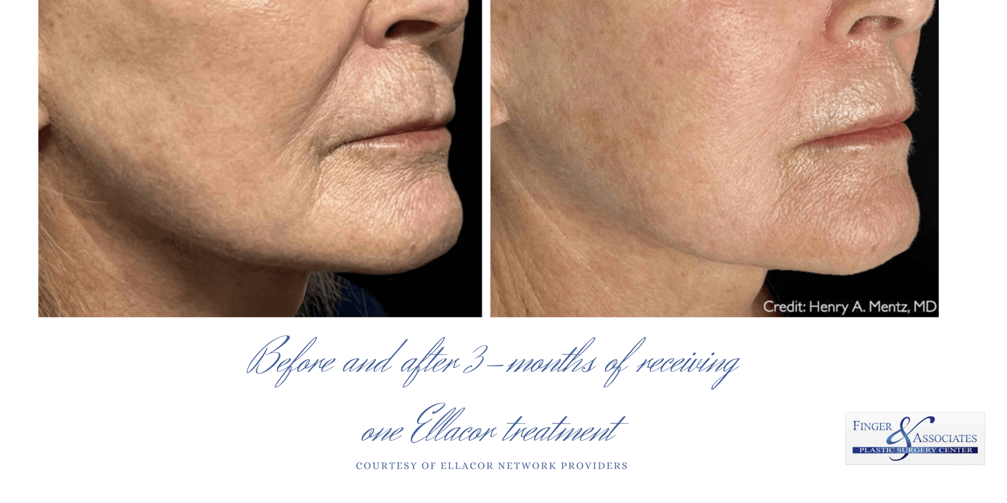 Before and after 3 months of one Ellacor procedure Ellacor skin tightening is now available in Savannah