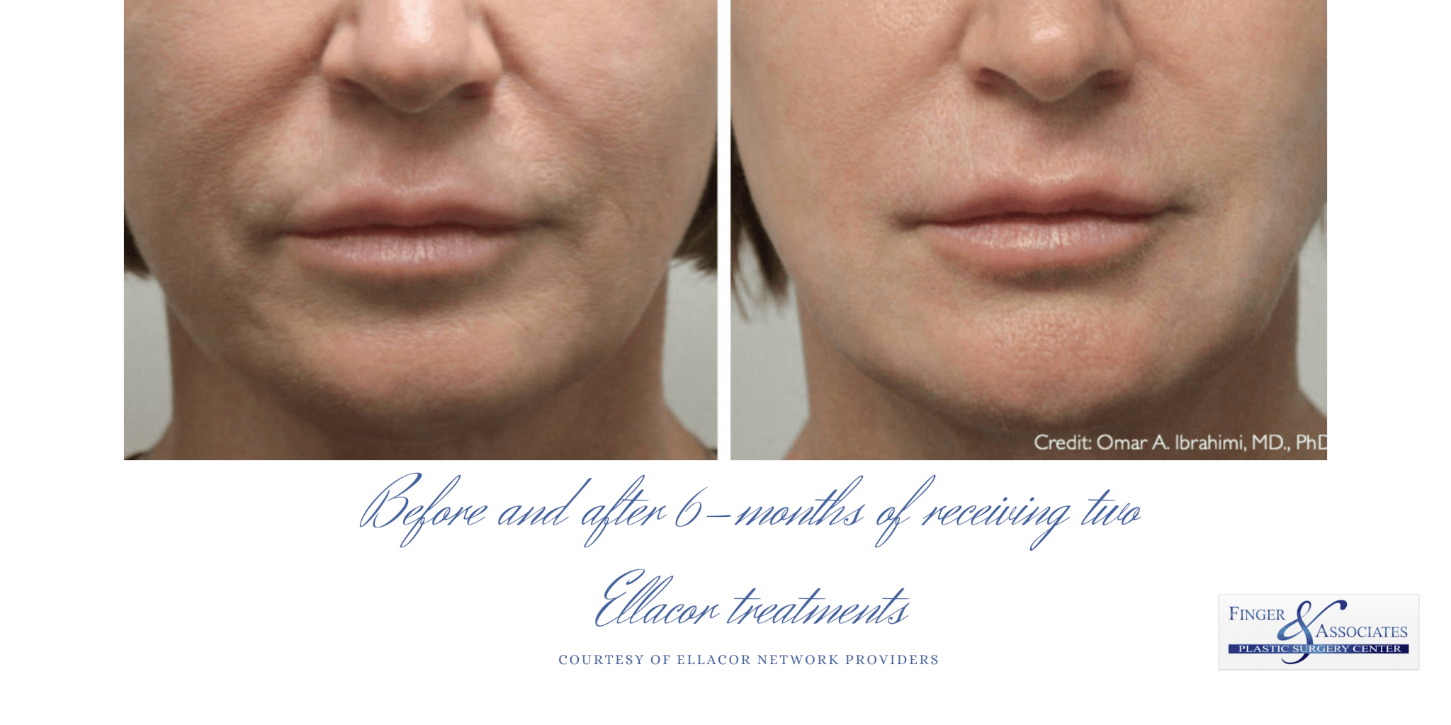 Before and after 6 months of 2 Ellacor procedures Ellacor skin tightening is now available in Savannah
