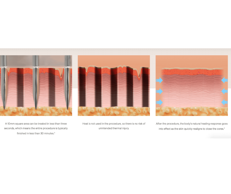 How it Works. Ellacor uses hollow needles to remove micro-cores of skin, resulting in an improved appearance of moderate and severe wrinkles in the mid and lower face without the evidence of scarring.1,2