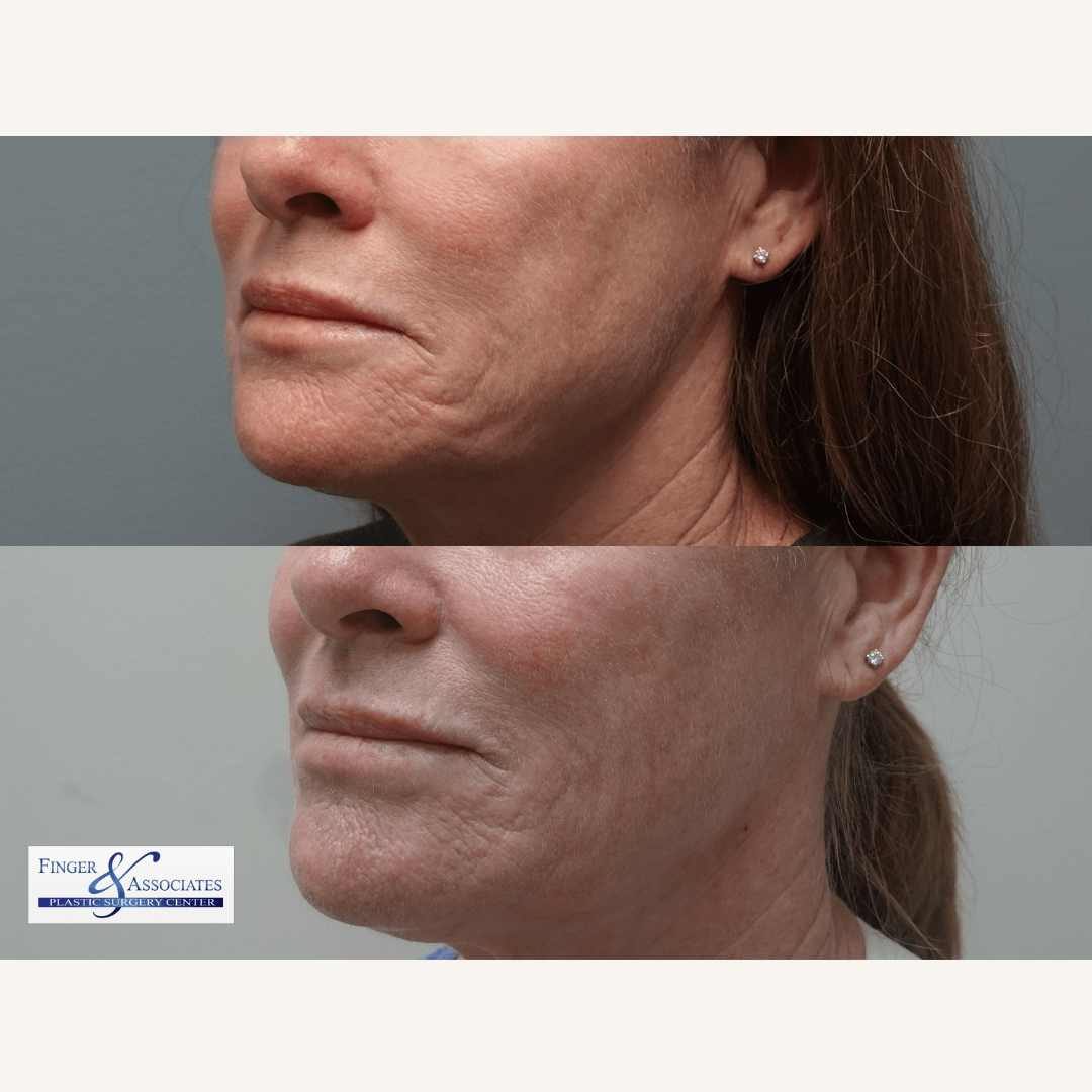 Before and After 2 months of receiving Ellacor for Skin tightening of the face by Dr Finger